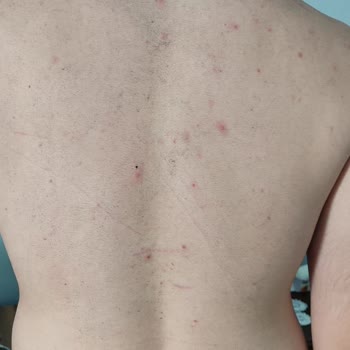 Sağlık Sorunları, Düzensiz Seanslar Ve İletişimsizlik Nedeniyle Enza Beauty Center’dan İade Talebi