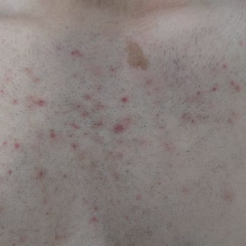 Sağlık Sorunları, Düzensiz Seanslar Ve İletişimsizlik Nedeniyle Enza Beauty Center’dan İade Talebi