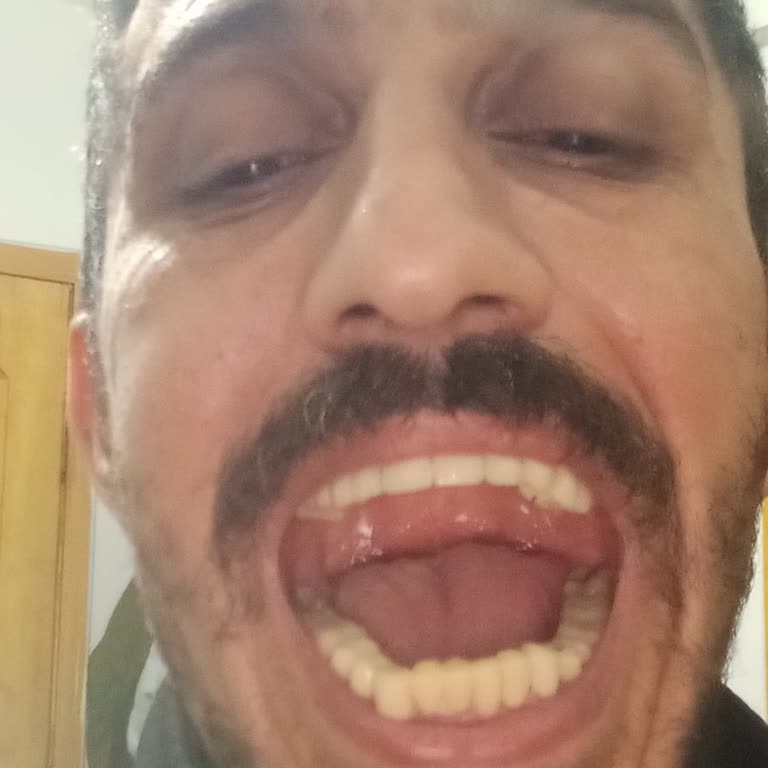 Geçmeli Protez Dişlerin Yanlış Boyutu Ve Şiddetli Ağrı