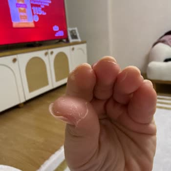 Pril Cold Power Deterjanı Kullanımı Sonrası Şiddetli El Tahrişi