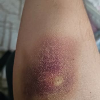 Kızılay’da Yanlış İğne Yerleştirilmesi Nedeniyle Şiddetli Ağrı Ve Yetersiz Yanıt