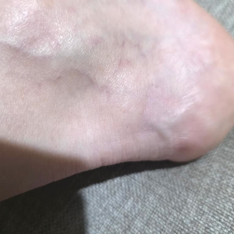 İlk Kullanımda Sol Ayakta Şişlik Ve Ağrı Yaratan Ayakkabı Üretim Hatası