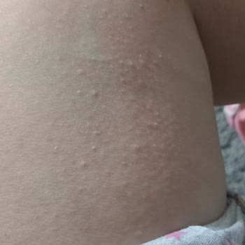 Koreaco Ürünleri Alerjik Reaksiyon Ve Hastane Tedavisi