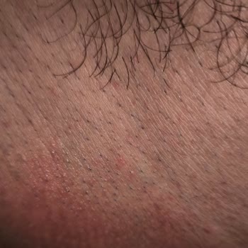 Epify Tüy Dökücü Kreminin Şiddetli Yanma Ve Kızarıklıkla Mağduriyeti