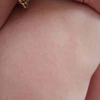 Bepanthol Ürünü Çocuğumda Şiddetli Alerjik Reaksiyon Yarattı, İade Talebi