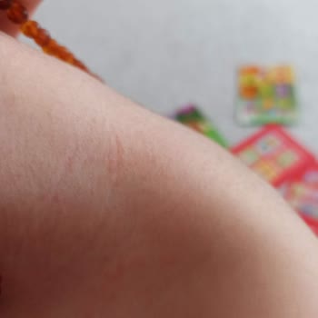 Bepanthol Ürünü Çocuğumda Şiddetli Alerjik Reaksiyon Yarattı, İade Talebi