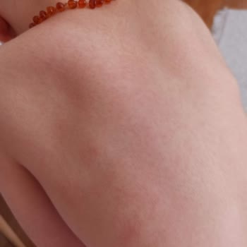 Bepanthol Ürünü Çocuğumda Şiddetli Alerjik Reaksiyon Yarattı, İade Talebi
