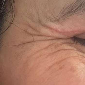 Estethica Şubesinde Etkisiz Botoks Ve Dolgu İşlemleri İçin Ücret İadesi Ve Denetim Talebi