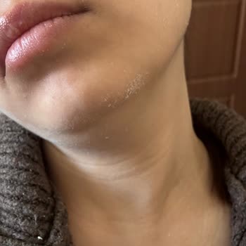 Yüzde Soyulma Ve Topaklanma Yaratan Yves Rocher Güneş Kremi Hayal Kırıklığı
