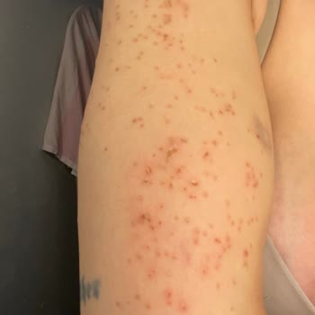 Bağcılar Şubesinde Lazer İşlemi Kalitesiz Ve İlgisiz, Ücret İadesi Talebi