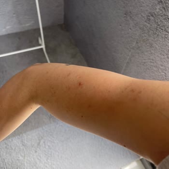 Bağcılar Şubesinde Lazer İşlemi Kalitesiz Ve İlgisiz, Ücret İadesi Talebi
