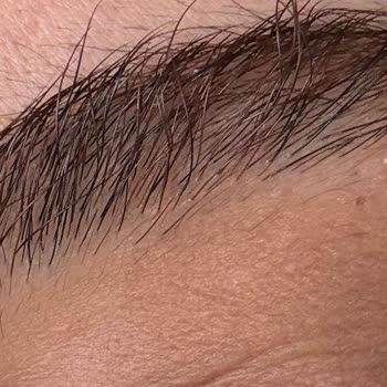 Hijyensiz Microblading İşlemi Sonrası Kalıcı Kaş Zedelenmesi Ve Büyük Maddi Zarar