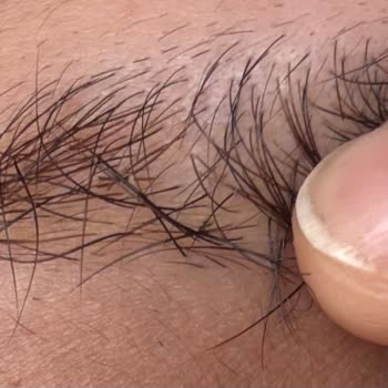 Hijyensiz Microblading İşlemi Sonrası Kalıcı Kaş Zedelenmesi Ve Büyük Maddi Zarar