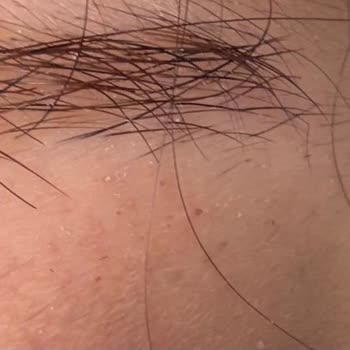 Hijyensiz Microblading İşlemi Sonrası Kalıcı Kaş Zedelenmesi Ve Büyük Maddi Zarar