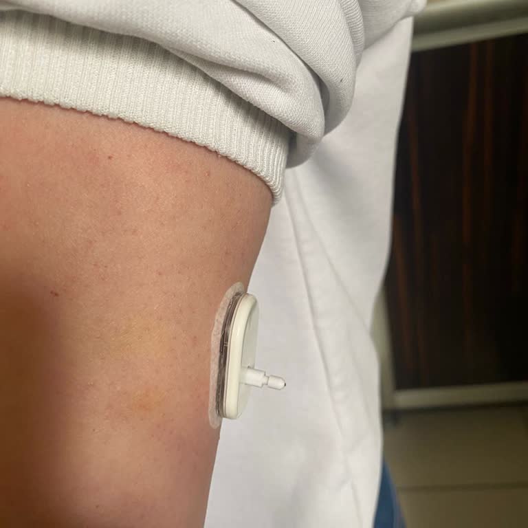 Sibionics CGM Sensör Arızası Ve Ücretsiz Değişim Talebi