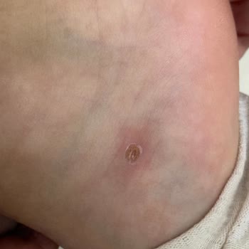 Terlikten Kesik Çocuğumun Ayağını Yaraladı Ve Enfekte Etti