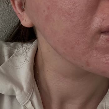 La Roche Posay Anthelios 100 Ka+ Kullanımında Ciddi Cilt Reaksiyonu