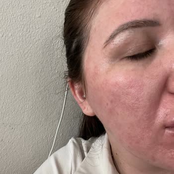 La Roche Posay Anthelios 100 Ka+ Kullanımında Ciddi Cilt Reaksiyonu