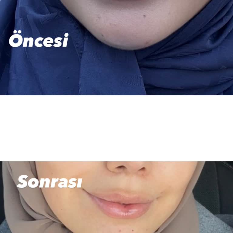 Dudak Dolgusu Etkisiz, Asistan Ve Doktorun Yaklaşımı Profesyonel Değil