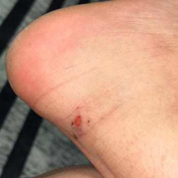Skechers Ayakkabısının Ayak Yaralanması Ve İade Sorunu