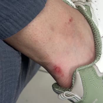 Skechers Ayakkabısının Ayak Yaralanması Ve İade Sorunu