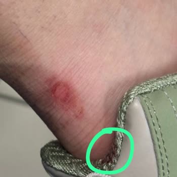 Skechers Ayakkabısının Ayak Yaralanması Ve İade Sorunu