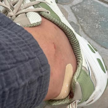 Skechers Ayakkabısının Ayak Yaralanması Ve İade Sorunu