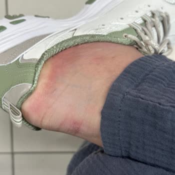 Skechers Ayakkabısının Ayak Yaralanması Ve İade Sorunu