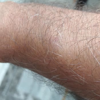 Aydın Şehir Hastanesi'nde Damar Yolu Açmada Yetersiz Tecrübe Ve Hastanın Çektiği Acı
