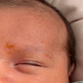 Bebekte Kızarıklık Ve Alerjik Reaksiyon Sonrası Mustela Şampuan Ve Losyon İncelemesi Ve İade Talebi