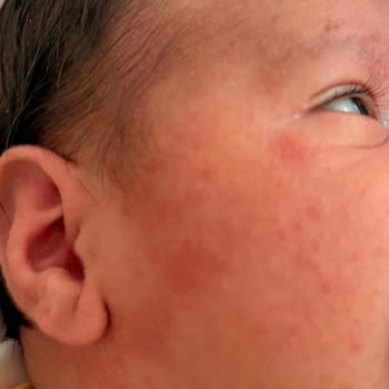 Bebekte Kızarıklık Ve Alerjik Reaksiyon Sonrası Mustela Şampuan Ve Losyon İncelemesi Ve İade Talebi