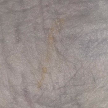 Dalın Islak Mendil Kullanımı Sonrası Bebeğimde Şiddetli Pişik Ve Kanama