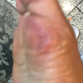 Camper Sandaleti İki Günde Bozuldu, Ayaklarım Ciddi Şekilde Yaralandı