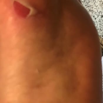Camper Sandaleti İki Günde Bozuldu, Ayaklarım Ciddi Şekilde Yaralandı