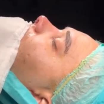 Burun Estetik Ve Deformite Ameliyatında Çökme, Eğrilik Ve Doktor Geri Dönüşsüzlüğü