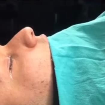 Burun Estetik Ve Deformite Ameliyatında Çökme, Eğrilik Ve Doktor Geri Dönüşsüzlüğü