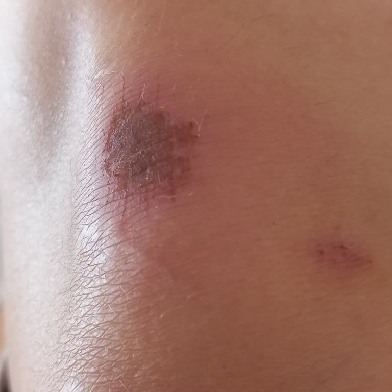 Yüksek Topuklu Ayakkabıda Dengesizlik Ve Düşme Sorunu