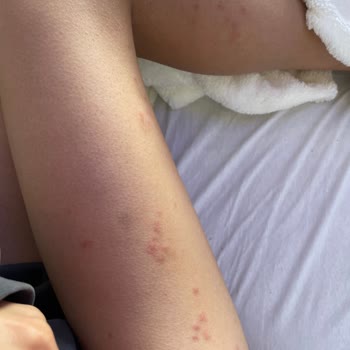 Otobüste Böcek Isırıkları Ve Sağlık Sorunu