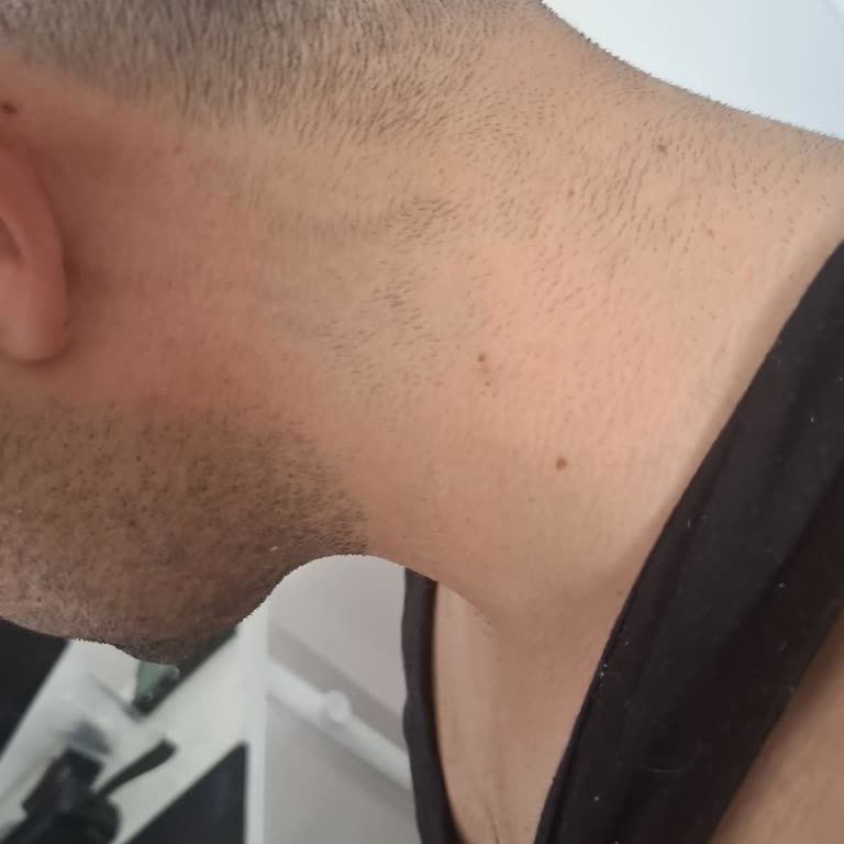 Yanık İzleri Ve Fahiş Ücret Artışı