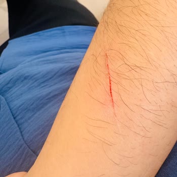 Dondurma Dolabındaki Sivri Metal Parçası Bileğimi Kesti, Mağaza Güvenliği Hiç Düşünülmedi