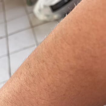 Yelsa Güzellik Salonu'nda Lazer Epilasyon Sonuçları Beklentileri Karşılamadı Ve İade Talebi