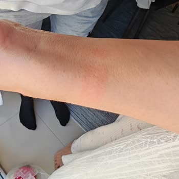 Bilek Tahrişi Yapan Swatch Saat İçin Ücret İadesi Talebi