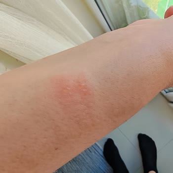 Bilek Tahrişi Yapan Swatch Saat İçin Ücret İadesi Talebi