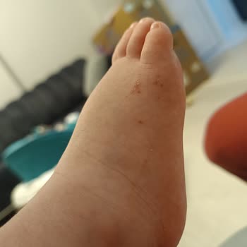 Prego Teddy Yürüteçte Oturak Yırtıkları Ve Ayıplı Ürün Şikayeti