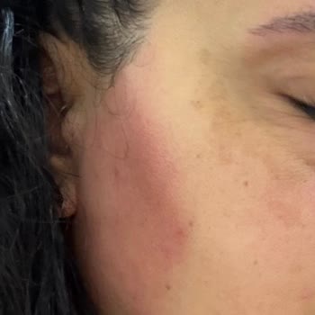 Bioderma Pigmentbio Ürünleriyle Şiddetli Alerjik Reaksiyon