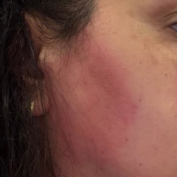 Bioderma Pigmentbio Ürünleriyle Şiddetli Alerjik Reaksiyon