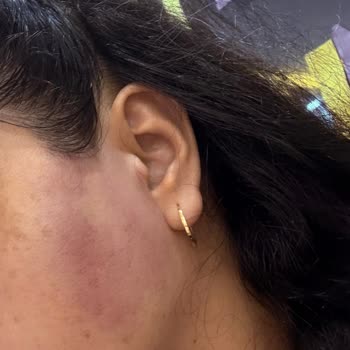 Bioderma Pigmentbio Ürünleriyle Şiddetli Alerjik Reaksiyon