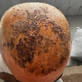 Dr. Ulusan Clinic Saç Ekimi Sonrasında Bende Süreç Son Derece Kötü İlerledi