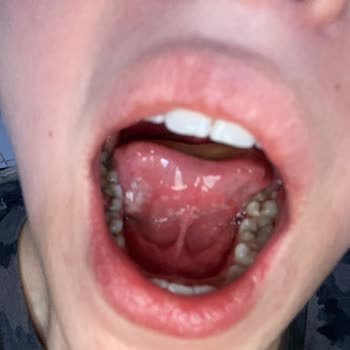 Sensodyne Diş Macunu Kullanımından Sonra Aft Benzeri Beyaz Yaralar Ve Şişlik