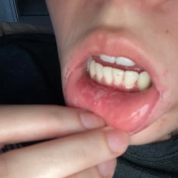 Sensodyne Diş Macunu Kullanımından Sonra Aft Benzeri Beyaz Yaralar Ve Şişlik